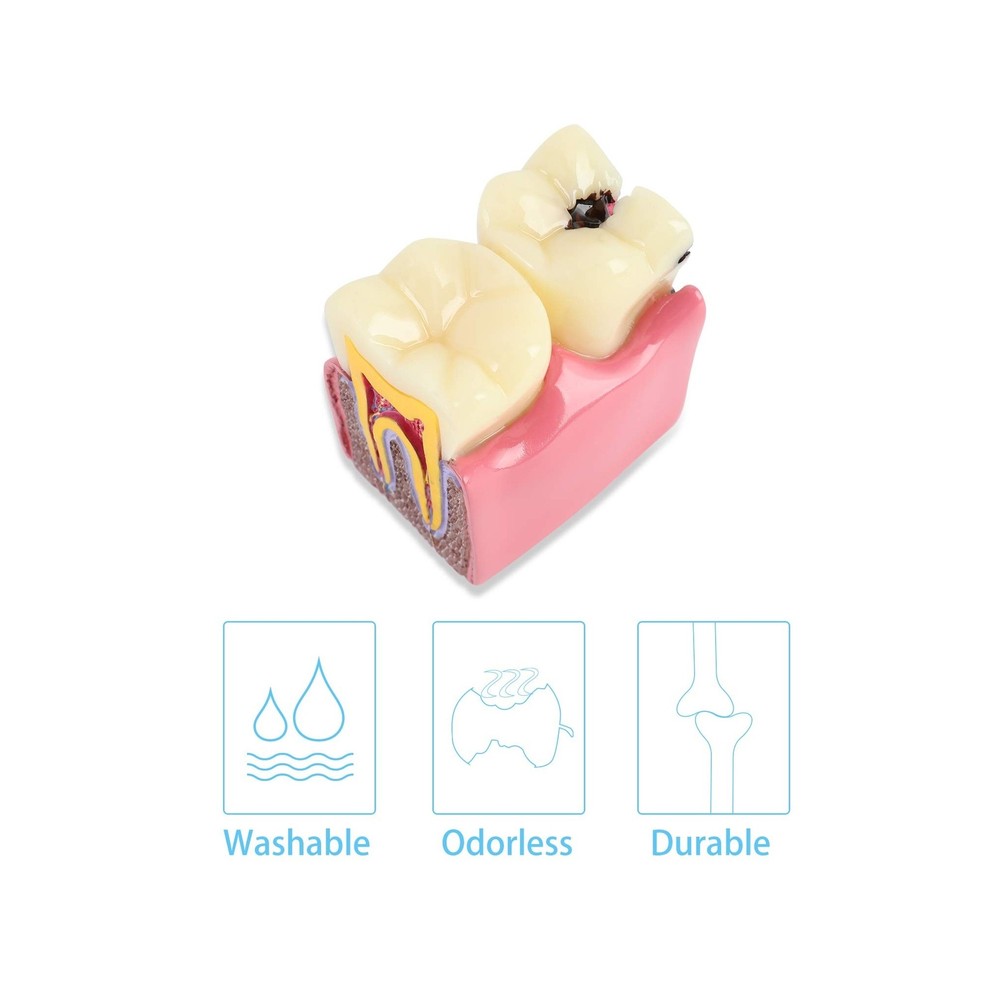 Dental Caries Tooth Model 6 Times Decay Teeth Comparative Study Model, Caries...