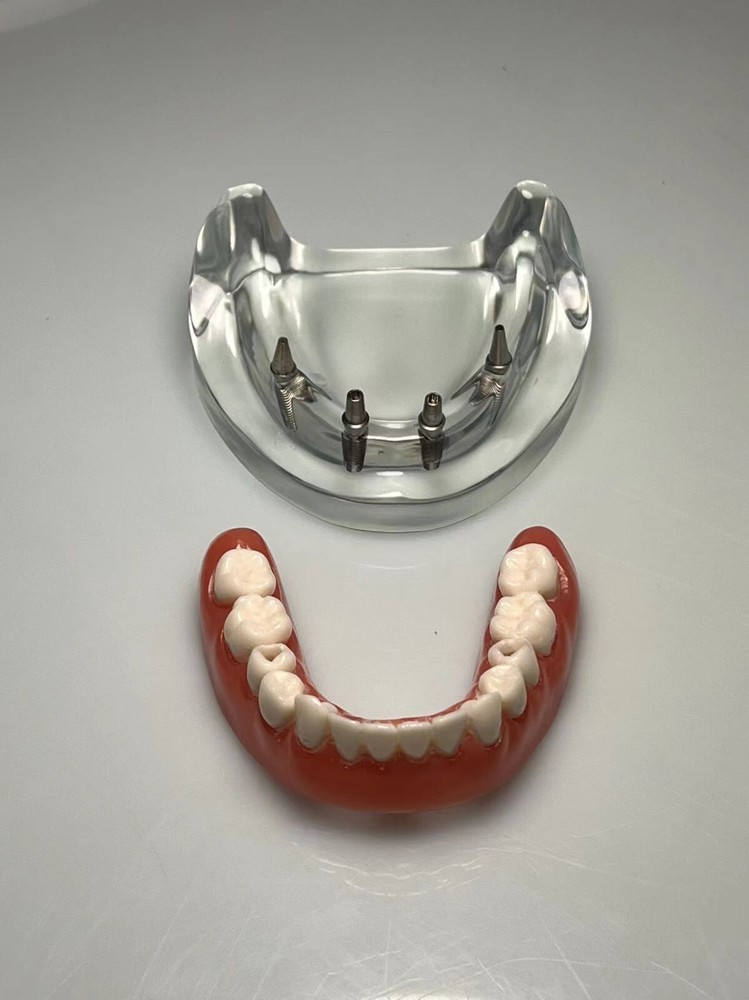 Dental Implant Restoration Model 4 Nails Denture Demonstration Model