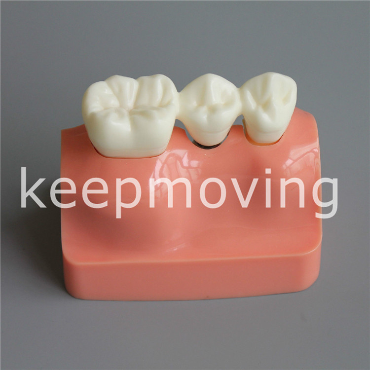 Dental Implant Analysis Crown Bridge Demonstration Teeth Tooth Model Typodont