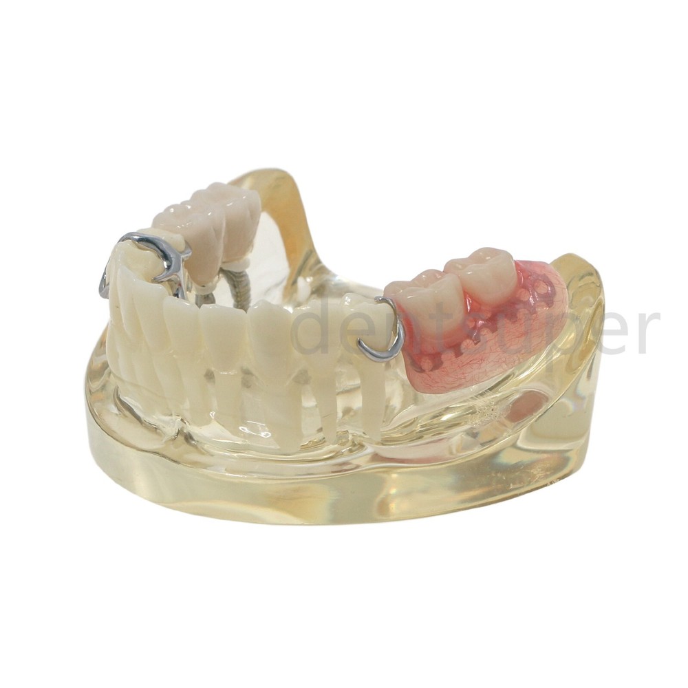 Typodont Restoration Dental Teeth Model With Partial Denture Demo 2 Implants