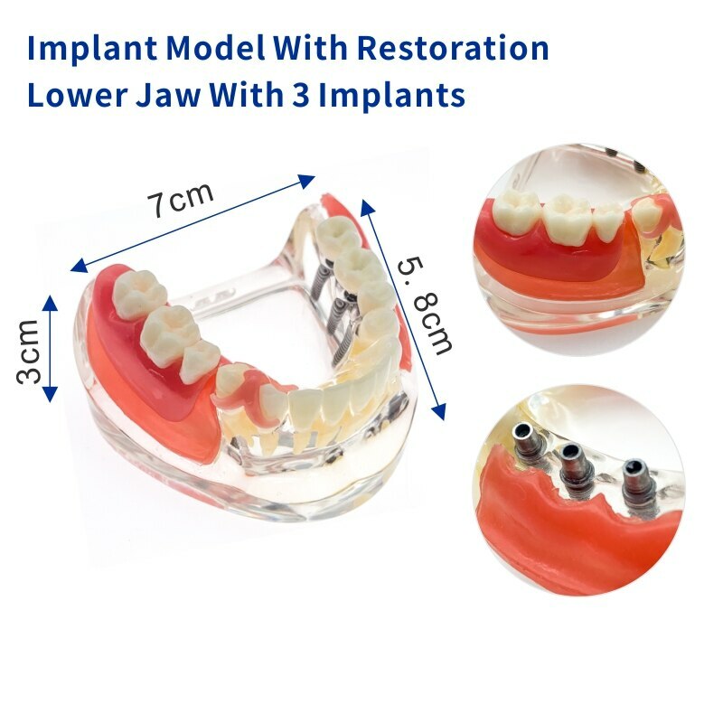 Removable Bridge Denture Teaching model Dental Implant Restoration Teeth Model