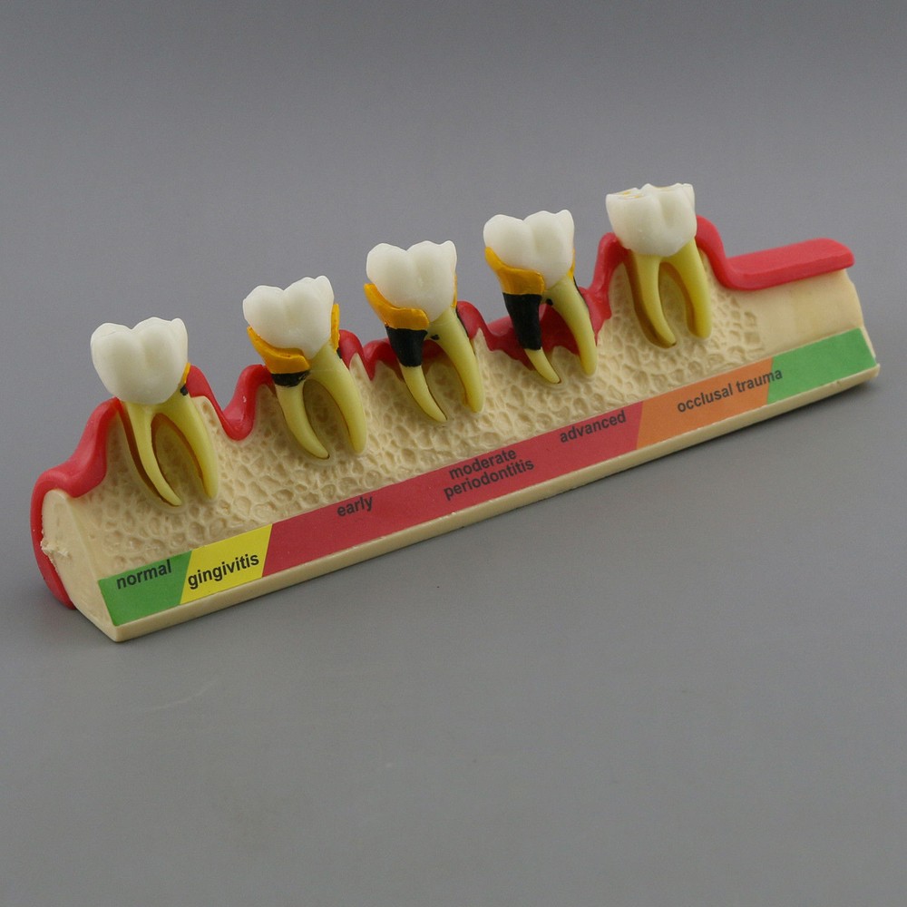 Dental Study Teaching Model Periodontal Disease Assort Teeth Dentoform Typodont