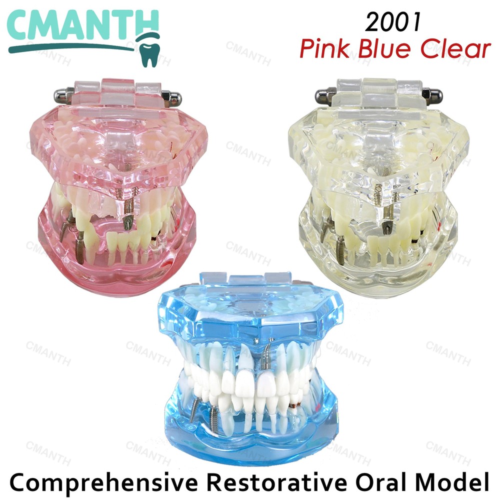 Dental Model Bridge Restoration Pathology Study Demo Teaching Model M2001