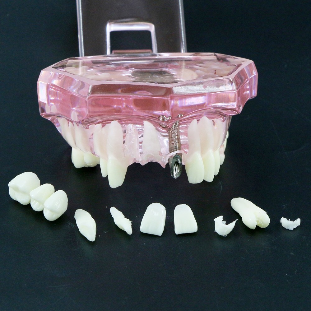 Dental Model Bridge Restoration Pathology Study Demo Teaching Model M2001