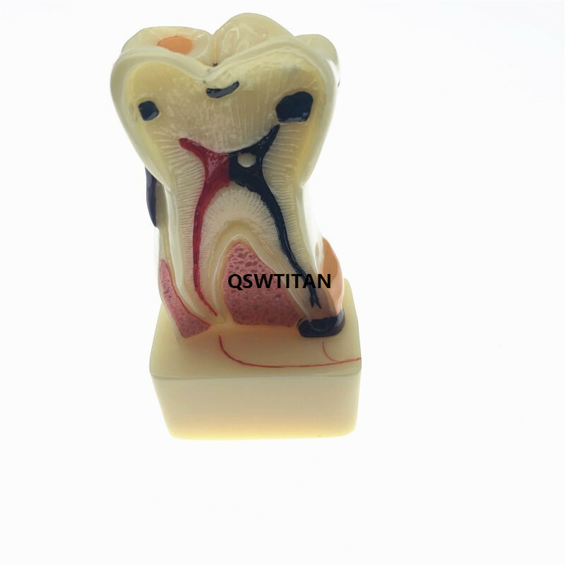 Teeth Model 4 times tooth pathology Comprehensive Periodontal teaching models
