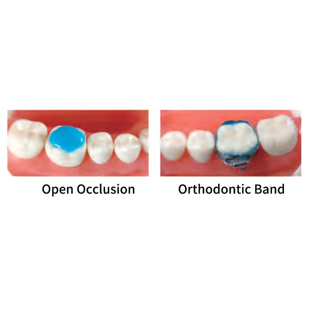 ORTHOBOND Light Cure Orthodontic Adhesive StandardKt (Blue)