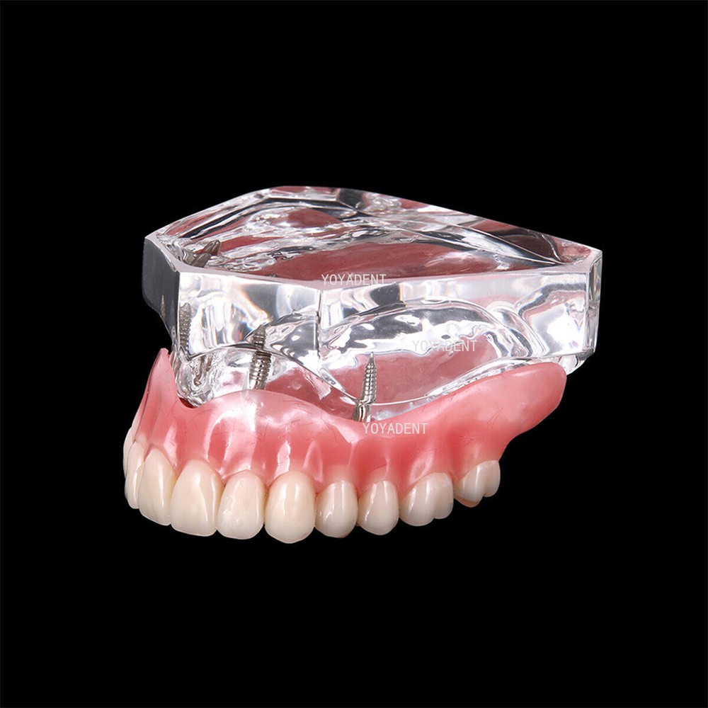 Dental Teeth Model Removable Overdenture Teeth Upper/Lower Jaw 4 Implants Model