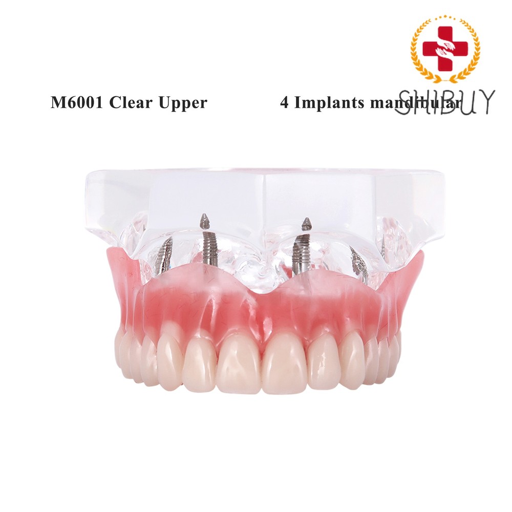 1pc Implant Overdenture Teeth Model Demo Restoration Upper 4 Implants