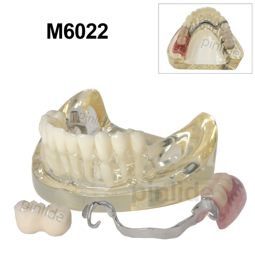 Dental Typodont Restoration Model With 2 Implants Partial Denture Demo M6022