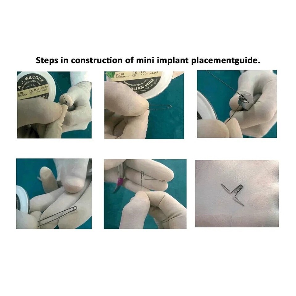 Australian Stainless Steel Wire for efficient orthodontic tooth alignment