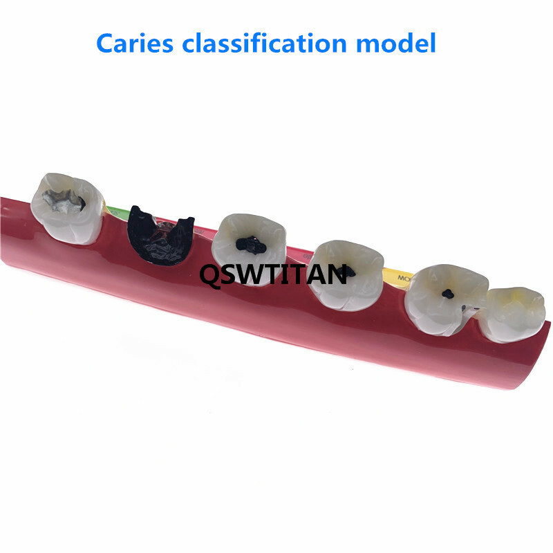 Dental Caries Classify/Evolution model Tooth Model Dental Study Model