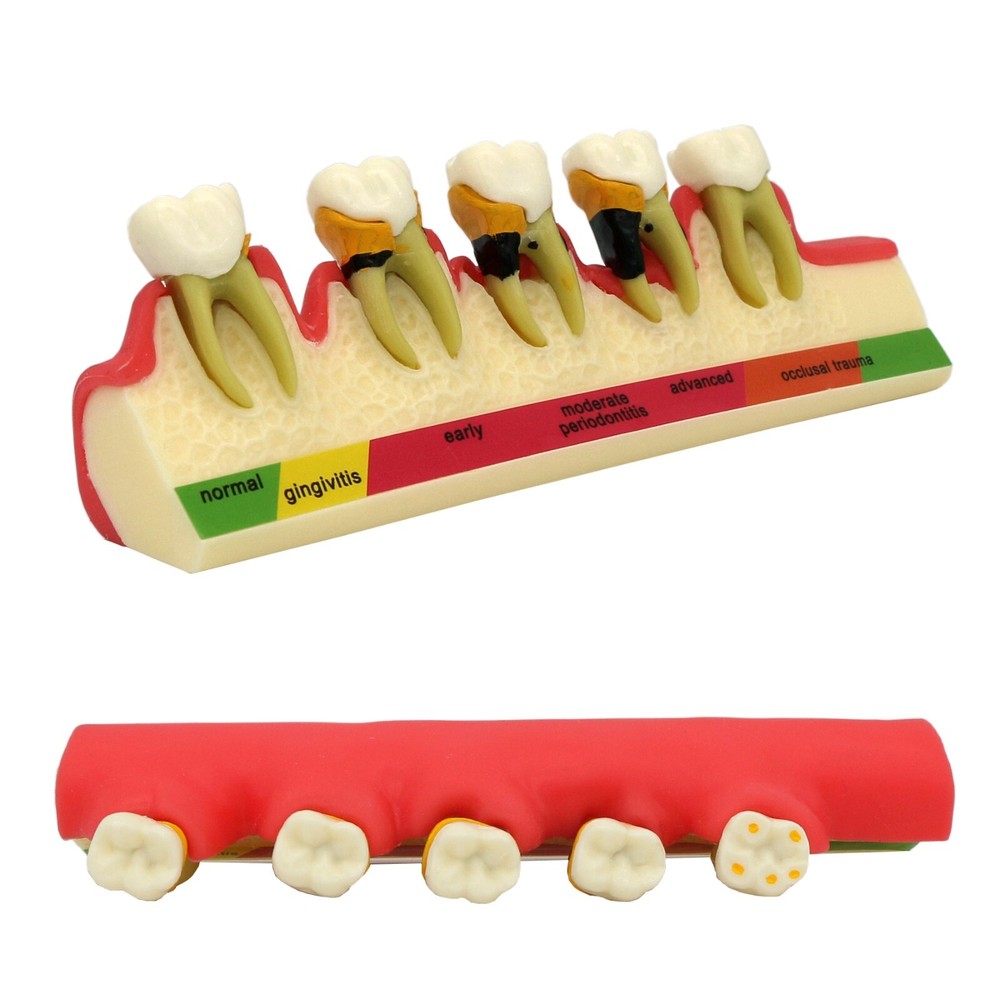 Dental Typodont Teeth Model Pathological Perio Implant Endo Caries Teeth Model