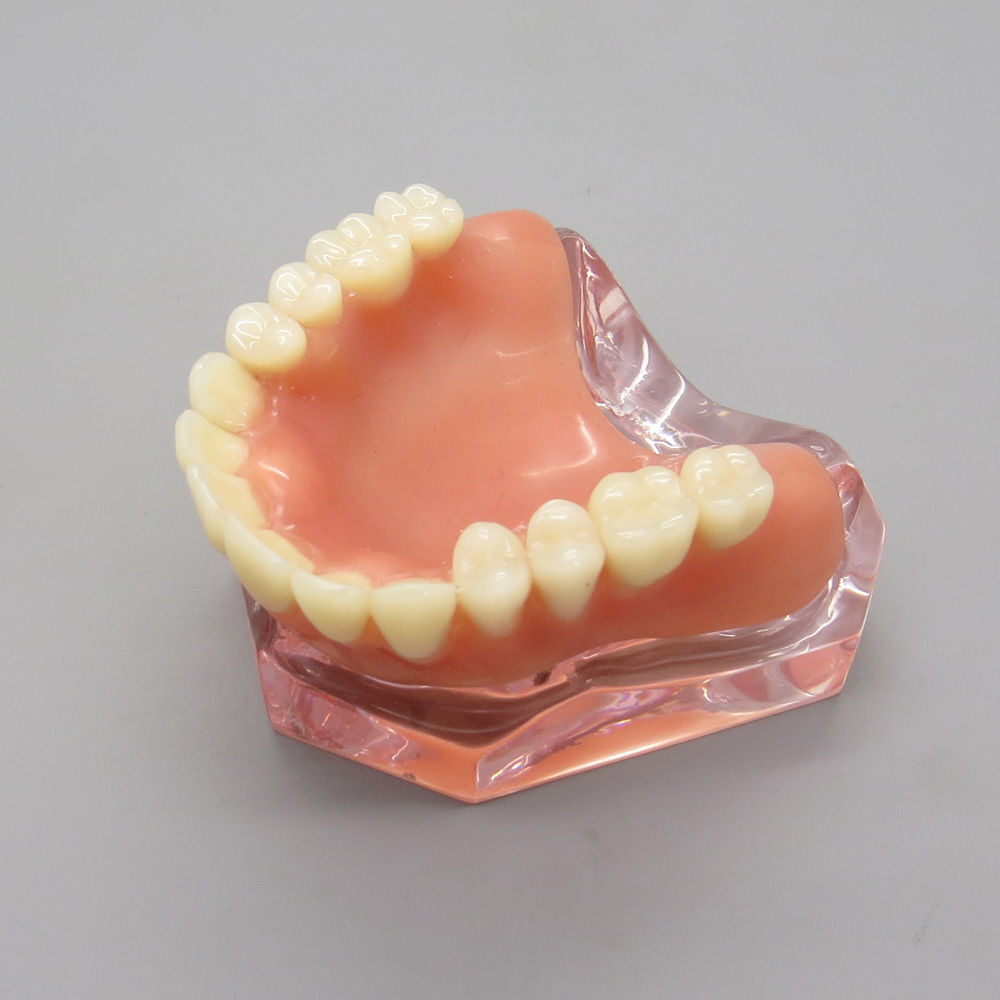 Dental Implant Teeth Model Demo Overdenture Restoration Teaching Study 4 Models