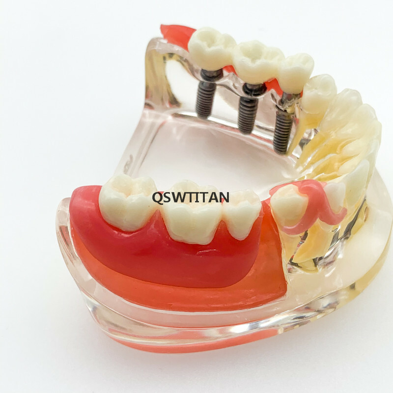 Dental Implant Restoration Model Removable Bridge Denture Teaching teeth model