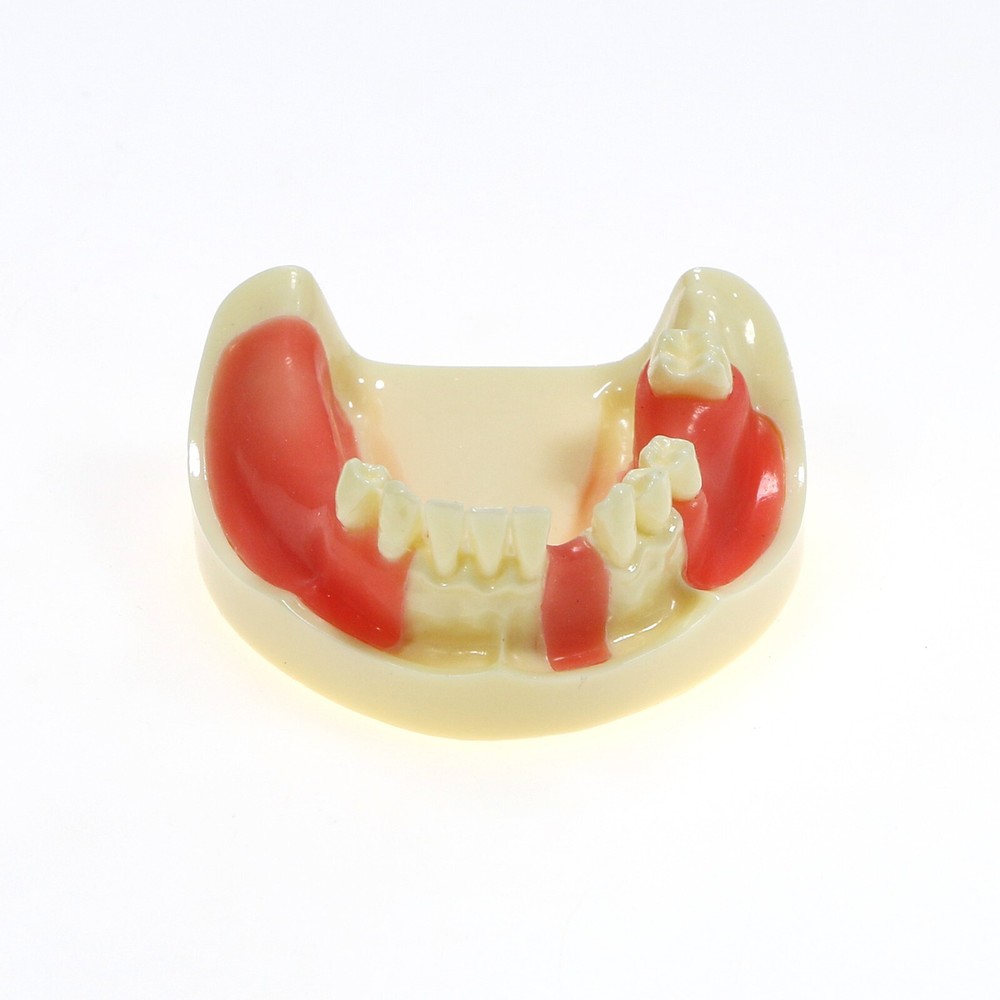Implant Teeth Model Dental Typodont Ortho Pathological Perio Practice Demo Model