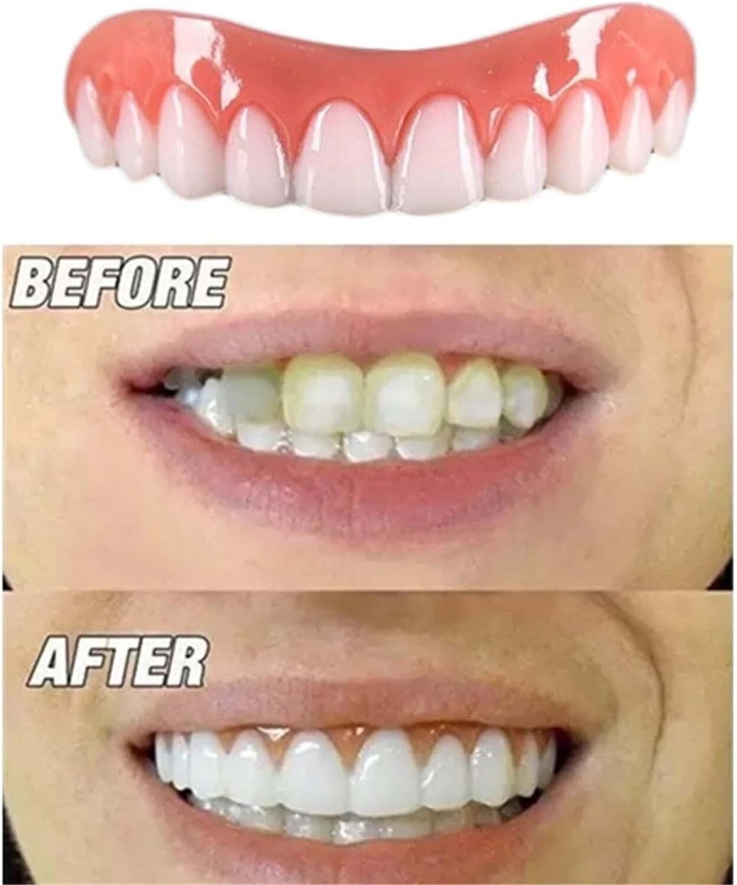 Instant Smile Natural Shade Complete Teeth Makeover Kit, Upper & Lower Veneers
