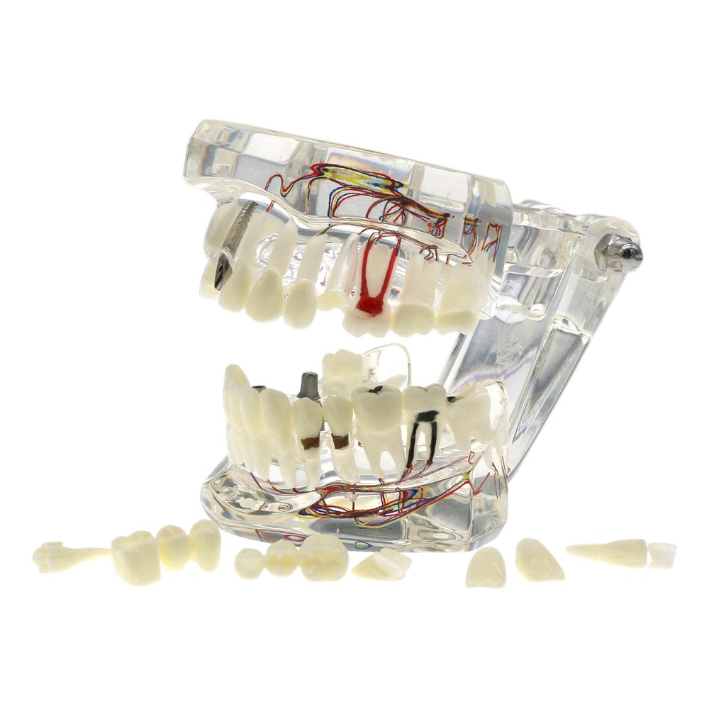 Dental Multi Typodont Teeth Model for Implant Pathological Restoration Practice