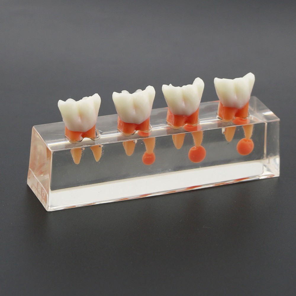 1 Set Dental Teeth Model #4018 01 - 4-Stage Endodontic Treatment Study Model