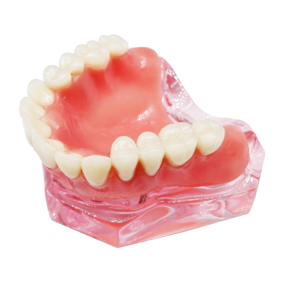Dental Implant Teeth Model Demo Overdenture Restoration With 4 Implants Upper