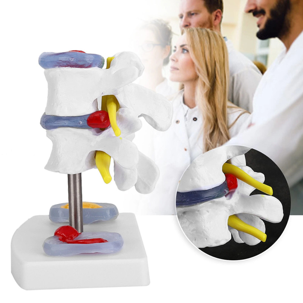 Anatomical Lumbar Disc Herniation Demonstration Model Human Spine School