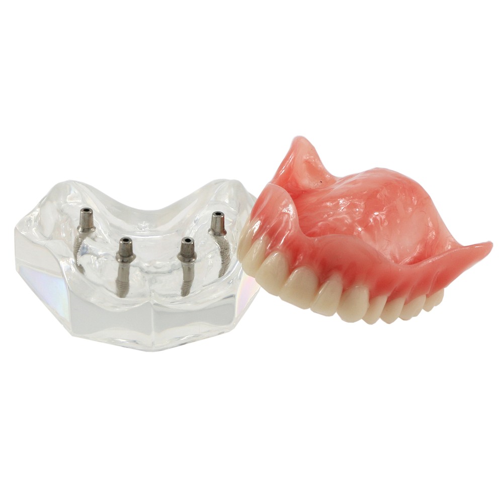 Dental Implant Teeth Model Restoration Overdenture Upper/Lower 4 Implants Demo