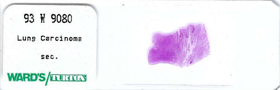 Human Carcinoma of Lung Pathology Microscope Slide