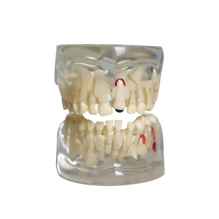 Dental Typodont Teeth Study Teach Tooth Model Implant Endo Caries Demonstration