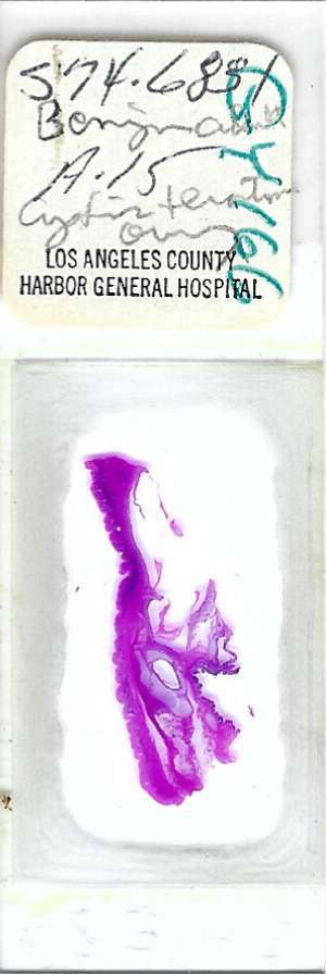 Human Benign Cystic Teratoma Ovary Pathology Microscope Slide