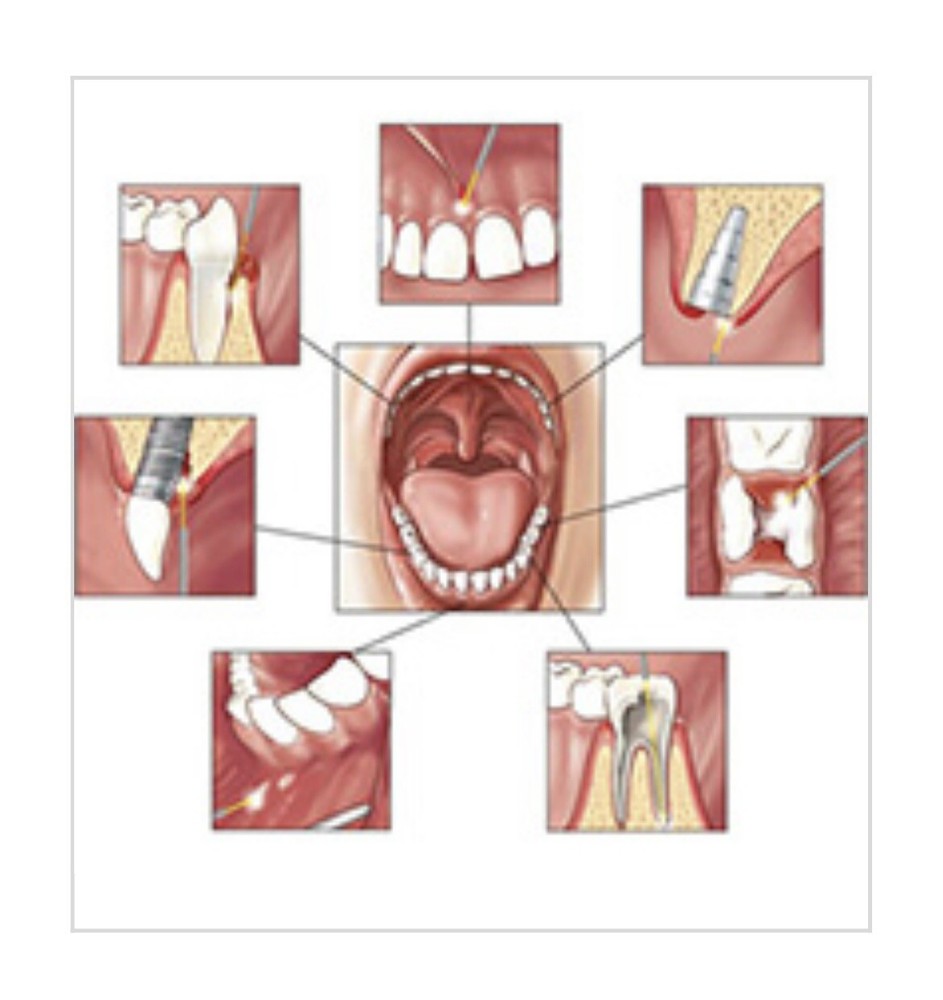 Dental Laser AMD Lite High Performance