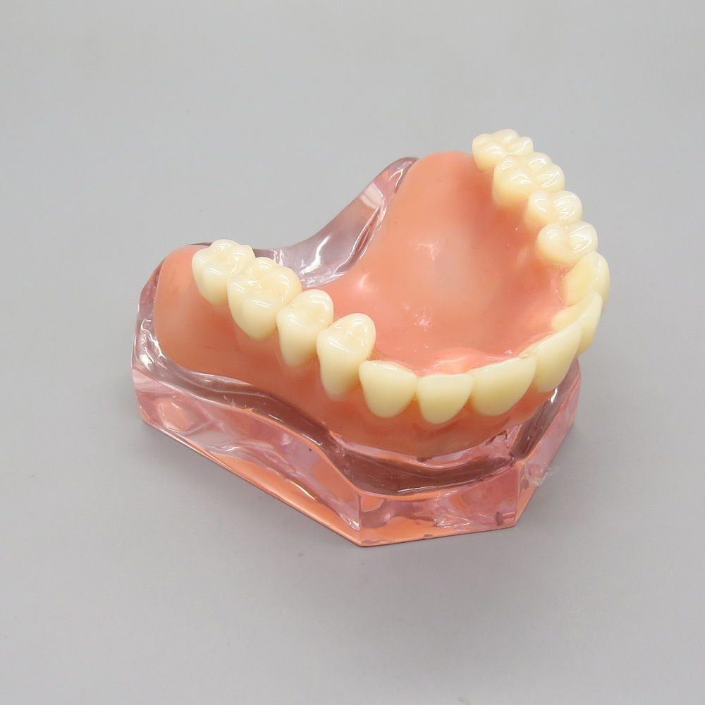 Dental Implant Teeth Model Demo Overdenture Restoration Teaching Study 4 Models