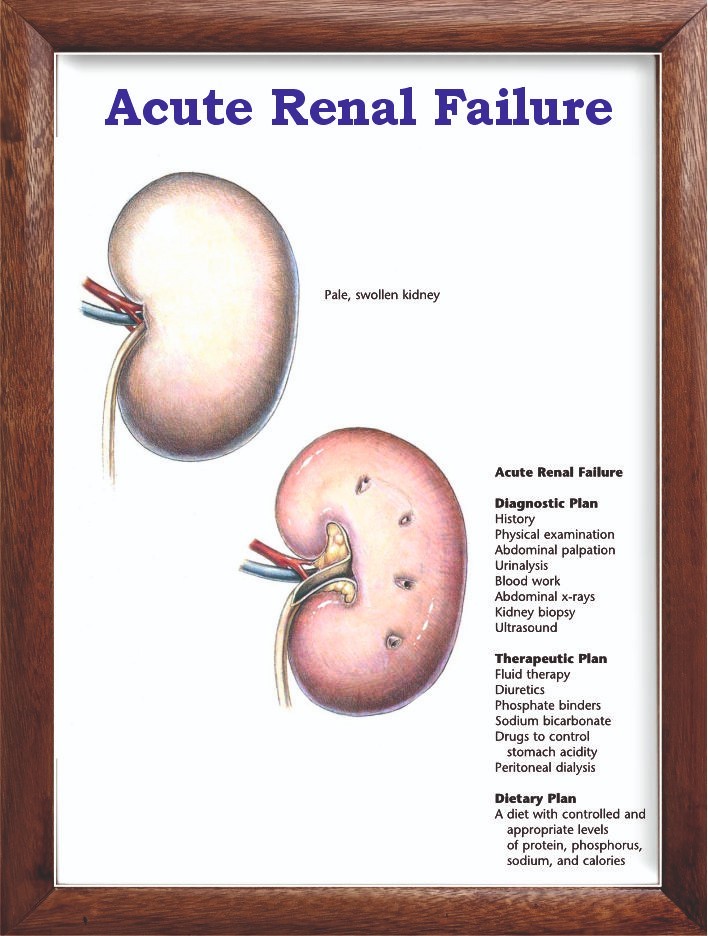 Acute Renal Failure Chart 12x18 inches