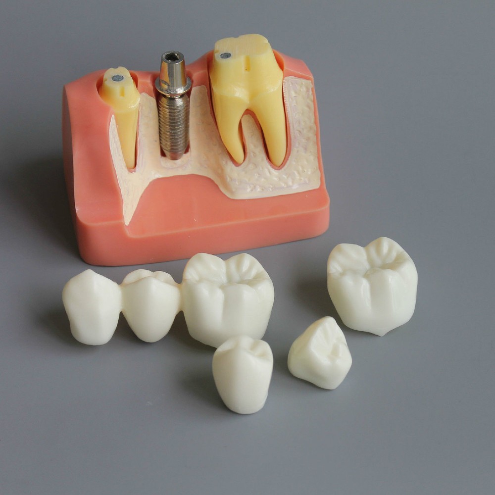 Dental Demonstration Removable Teeth Model Implant Analysis Crown Bridge Study