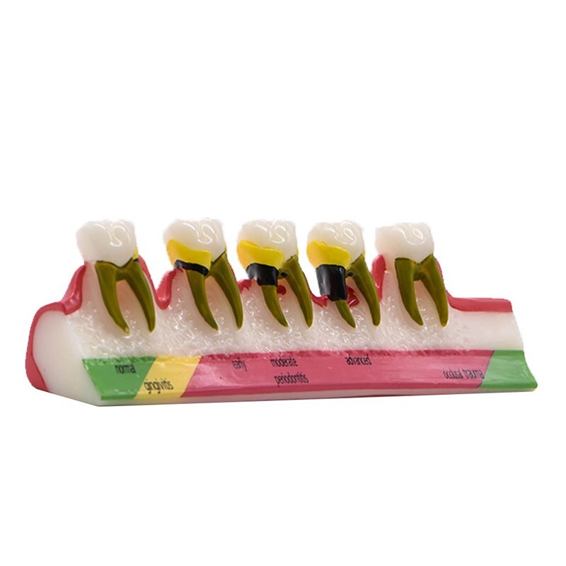 Dental Study Teaching Model Periodontal Disease Assort Teeth Dentoform Typodont