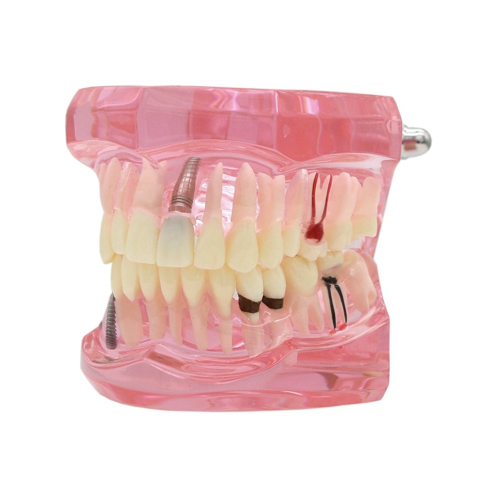 Dental Teeth Model Implant Bridge Restoration Pathology Study Demo Removable