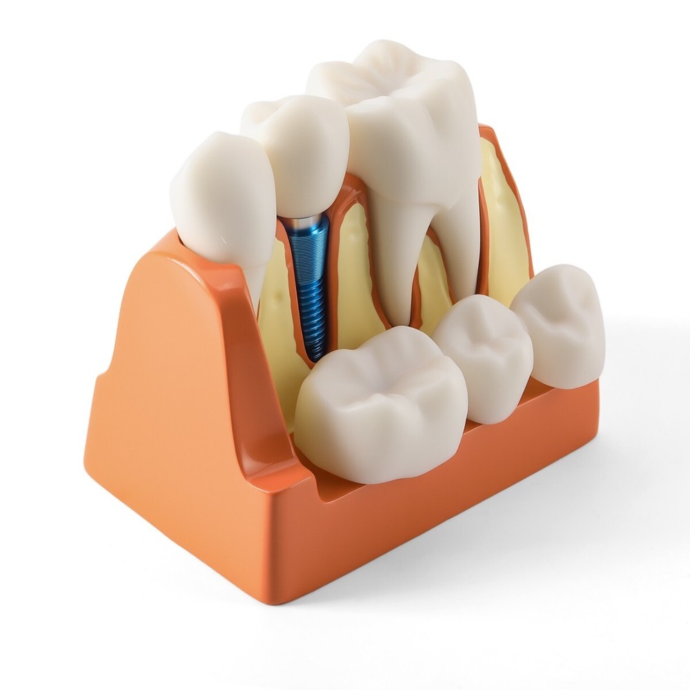 4 Times Dental Analysis Crown Bridge Demonstration Removable Teaching Model