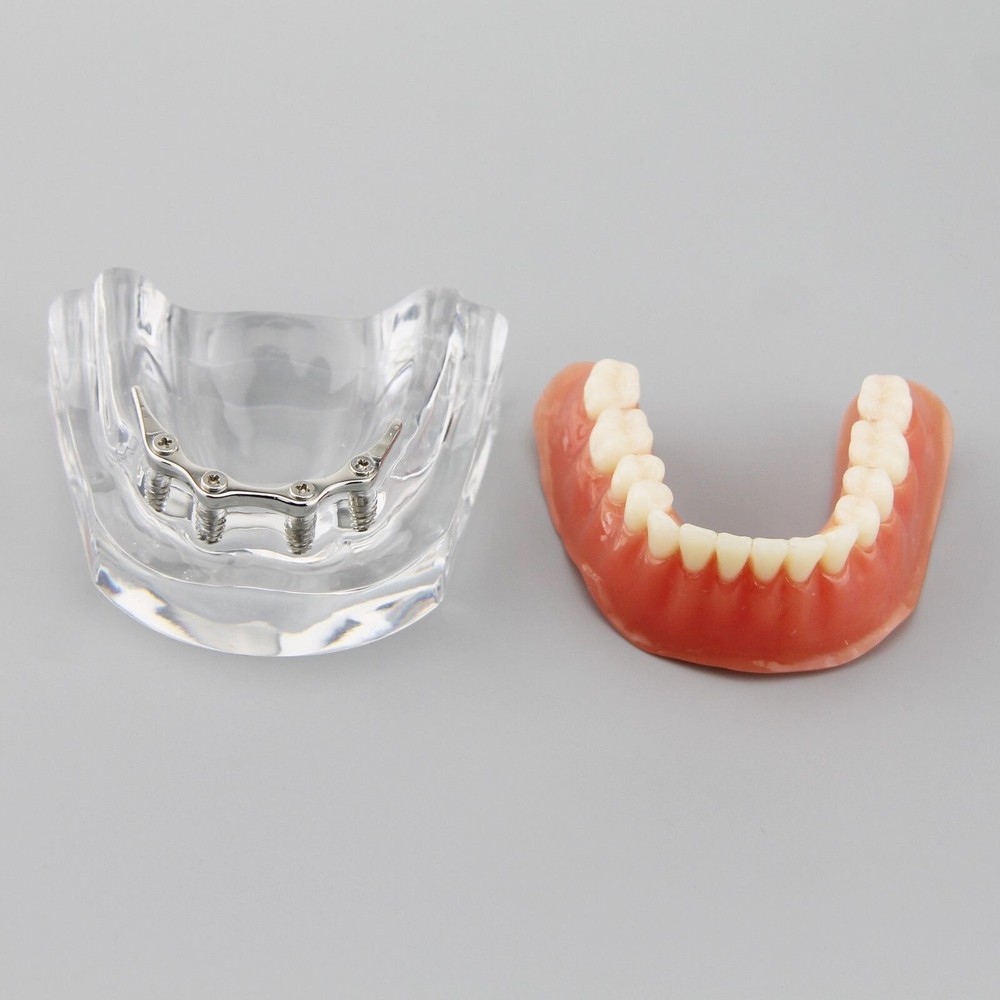 Dental Inferior Overdenture Model Lower Precision Implants With Silver Bar #6009