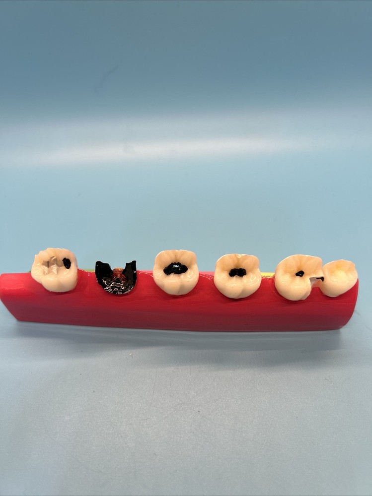 Dental Caries Developing illusteation teeth disease Tooth Model Demonstration