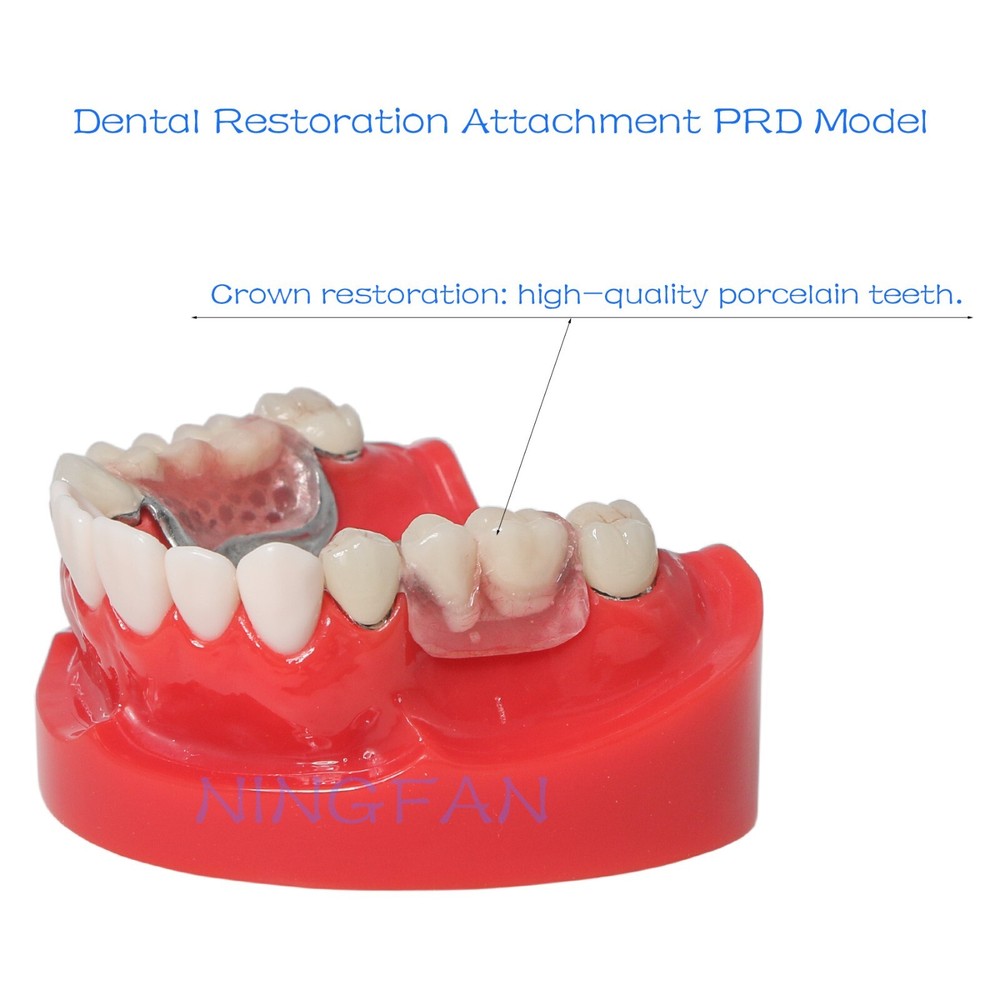 Dental Typodont Removable Partial Denture Model ,PRD Telescopic Crown Denture