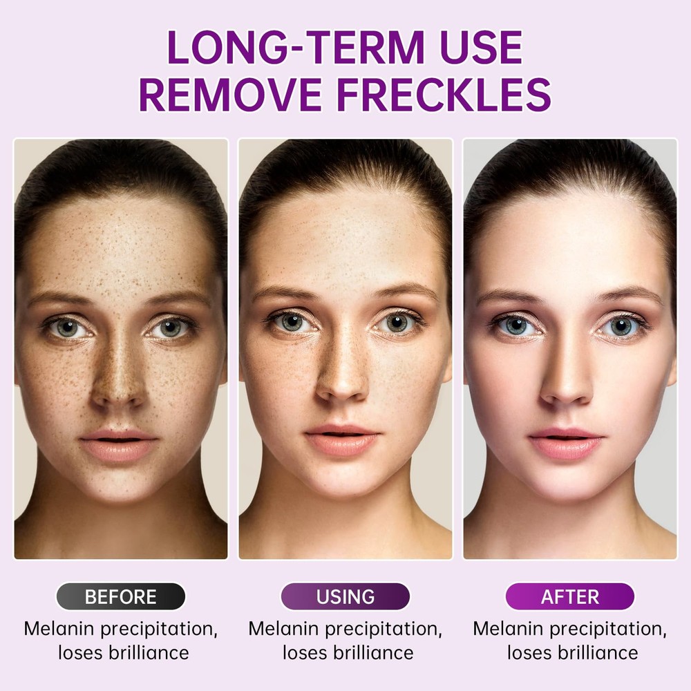Powerful Dark Spot Remover – Fast Brightening, Melasma and Pigmentation