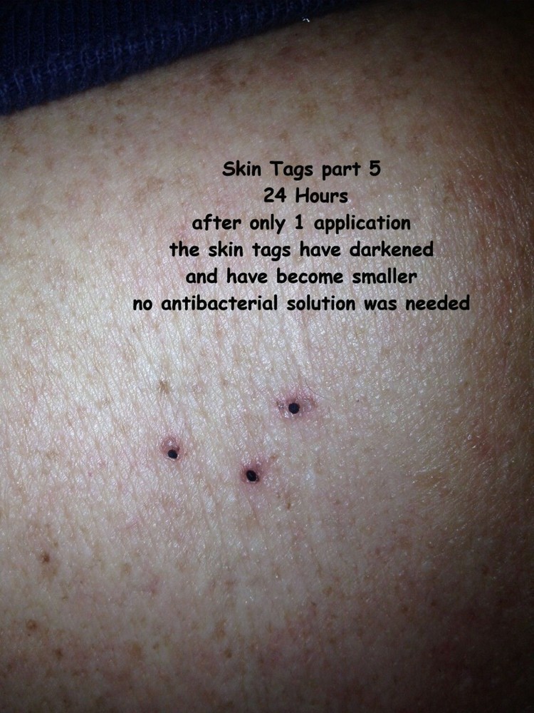 10ml Mole Wart and Skin Tag Remover