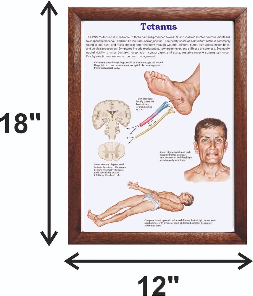 Tetanus Chart 12x18 inches