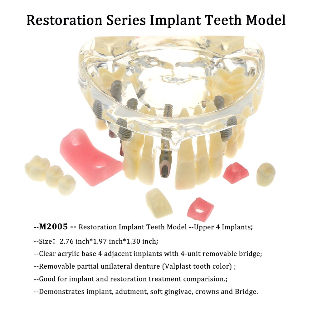 Detal Typondont Restoration Implant Teeth Model 2 3 4 Implants For Studying