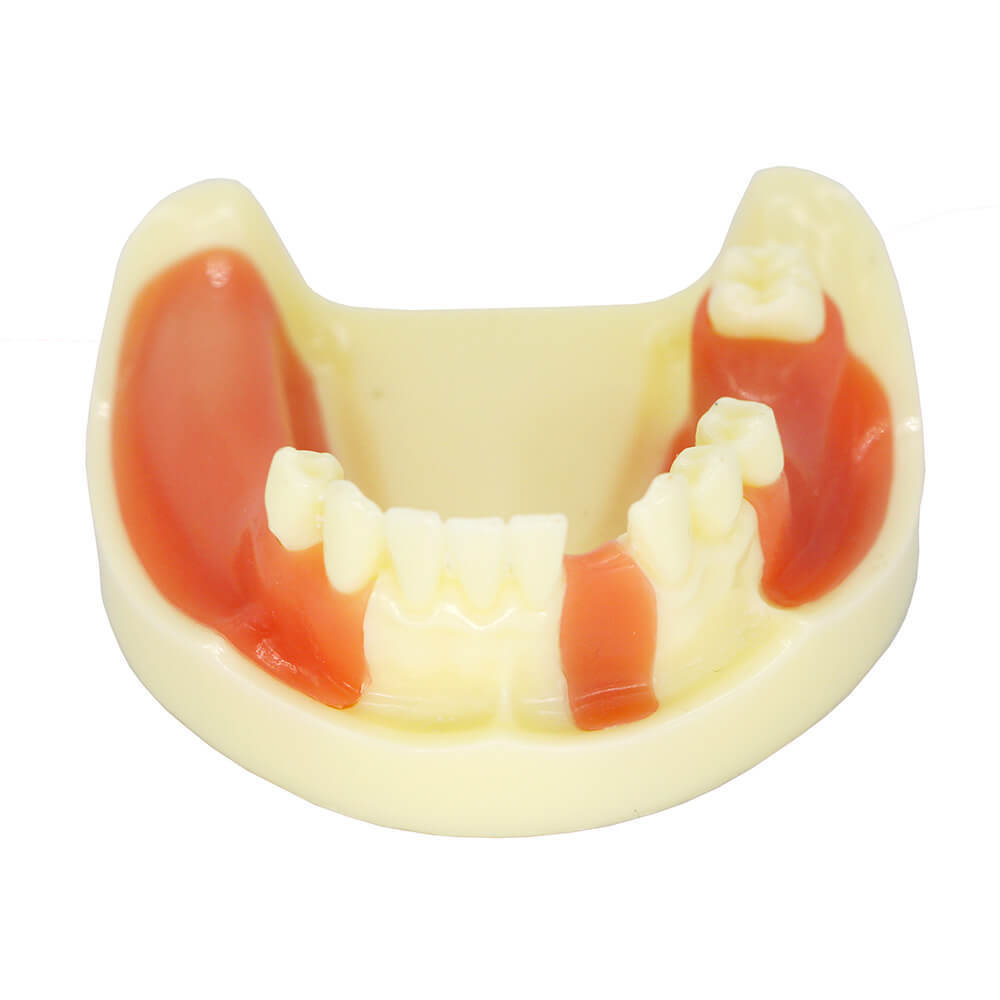 Dental Study Model with Bone Resorption & Missing Teeth for Implant Training