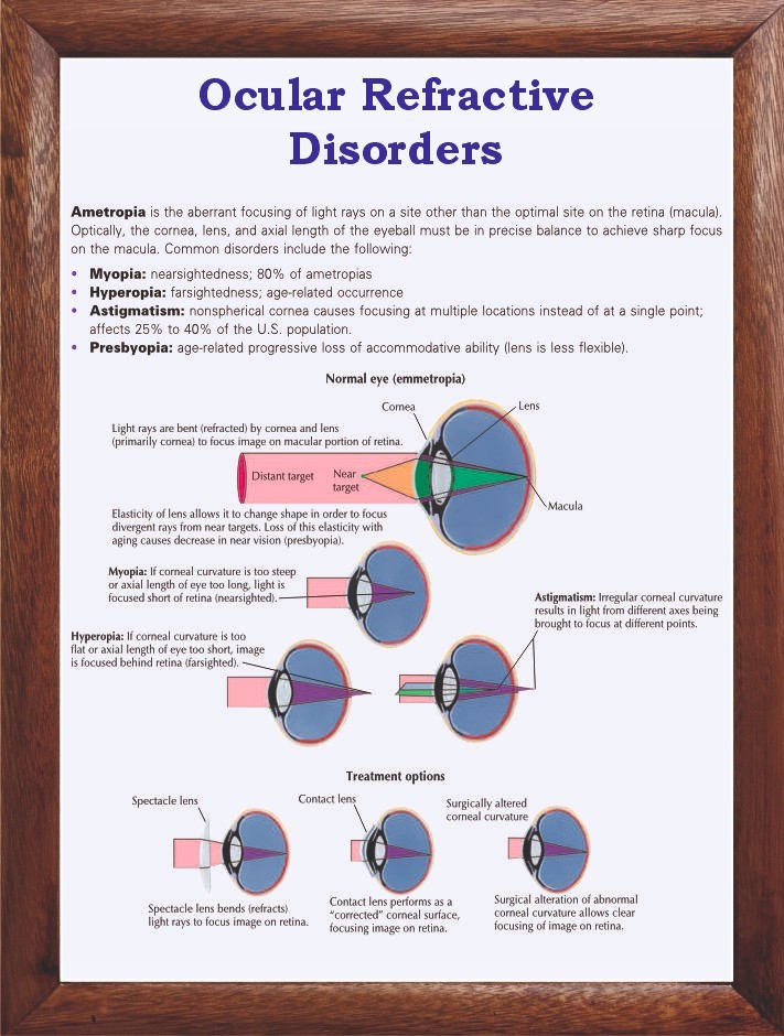 Ocular Refractive Disorders Chart 12x18 inches