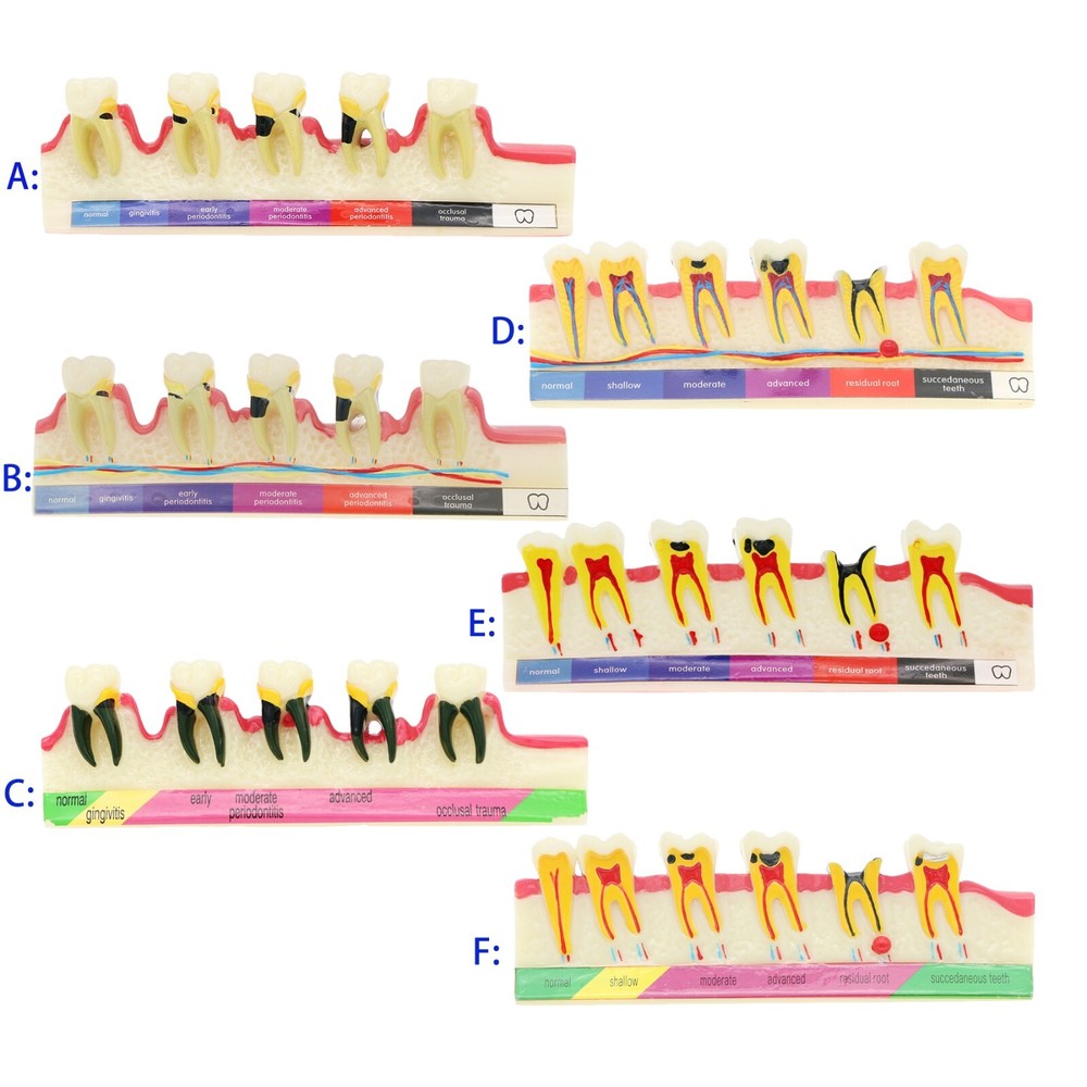 Multi Types Dental Typodont Teeth Model Implant Pathological Perio Practice Demo