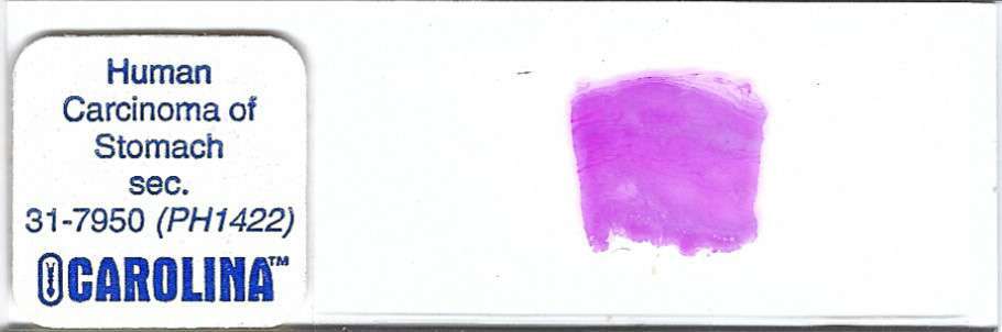Human Carcinoma of Stomach Pathology Microscope Slide