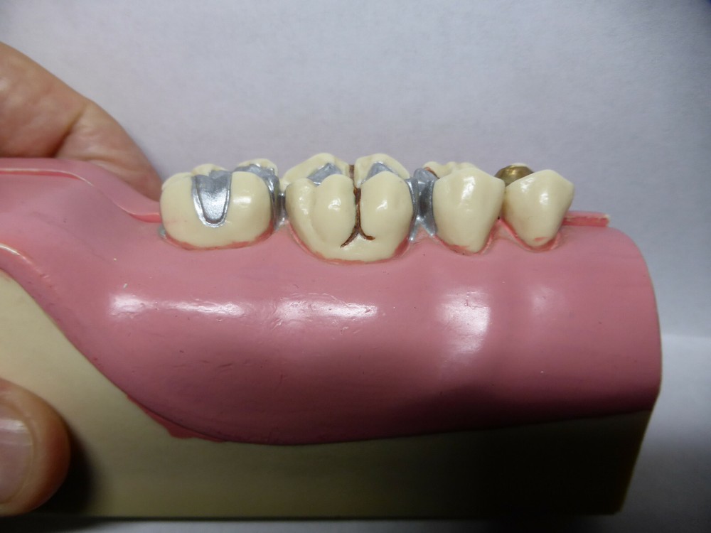Typodont, Common Dental Pathologies Model, Patient instruction, x- section