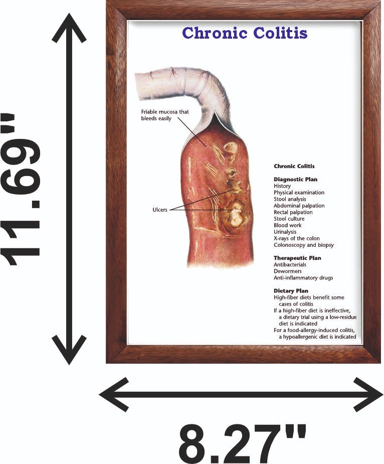 Chronic Colitis Chart 12x18 inches