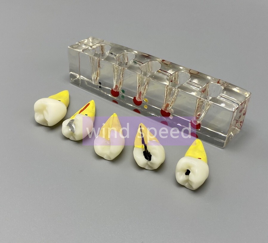 Dental Study Model Pulp Disease root canal curing Clinical Demonstration Analysi