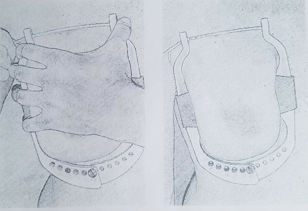 Breast Augmentation Implants Clamp Device Prevent Beat Capsular Contracture